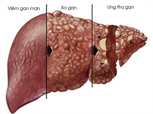 Viêm gan tiến triển thành ung thư gan